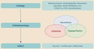 Image result for Stroke Pathophysiology
