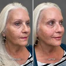 Albuquerque Full Face Balancing Before & After: Chrome Aesthetics