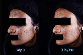 Efficacy of a dermocosmetic skin care regimen in reducing acne‐associated  post‐inflammatory hyperpigmentation in subjects with phototypes IV to VI