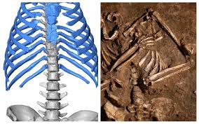 Rib cage pain is a common complaint that can be caused by factors, ranging from a fractured rib to lung cancer. 3 D Model Of Neanderthal Rib Cage Busts Myth Of Hunched Over Cavemen The Times Of Israel