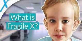 Fragile X Syndrome