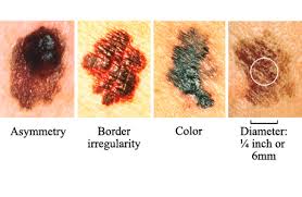 And it is important to recognize their signs and symptoms. Skin Cancer Haleh Bakshandeh Md
