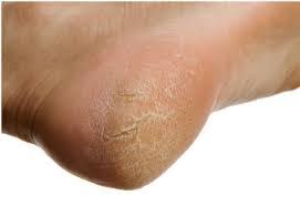 Dry Cracked Feet Oakhurst Ocean Nj Foot Doctor