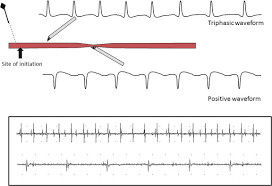 Fibrillation An Overview Sciencedirect Topics
