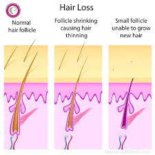 Hair loss in your 20s and 30s few people expect hair loss to happen as early as their 20s or 30s. Curly Hair Loss How To Stop Curly Hair From Thinning And Shedding