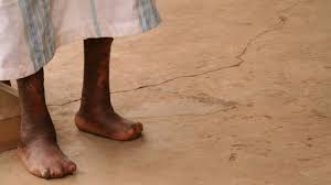Leprosy, chronic infectious bacterial disease that destroys peripheral nerves, resulting in loss of sensation and progressive tissue degeneration. Lepra Onmeda De