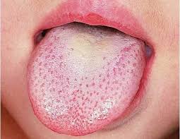 مرض الزهري لسان الانسان الزهري. Ø¨ÙŠØ§Ø¶ Ø§Ù„Ù„Ø³Ø§Ù† Ø£Ø³Ø¨Ø§Ø¨ Ø¸Ù‡ÙˆØ±Ù‡ ÙˆÙƒÙŠÙÙŠØ© Ø¹Ù„Ø§Ø¬Ù‡ ÙˆØ§Ù„Ø§Ù…Ø±Ø§Ø¶ Ø§Ù„ØªÙŠ Ù„Ù‡Ø§ Ø¹Ù„Ø§Ù‚Ø© Ø¨Ø¨ÙŠØ§Ø¶ Ø§Ù„Ù„Ø³Ø§Ù† Ø¬Ø¯Ø±Ø§Ù† Ø¹Ø±Ø¨ÙŠØ©