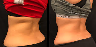1,108 likes · 759 talking about this. Best Coolsculpting Specials Near Me Nj Body Fat Reduction Cost