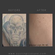 Laser tattoo removal works by producing pulses of light that pass through the layers of the skin and are absorbed by the tattoo pigment. Picosure Tattoo Removal Treatment Austin Med Spa