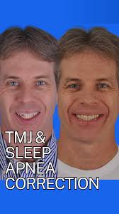 Chronic TMJ pain and sleep apnea can stem from jaw misalignment. In cases  like this, orthognathic surgery not only relieves pain—it improves  breathing, sleep, and overall function. Dr. Sherry explains ...