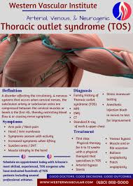 Thoracic Outlet Syndrome Tos Arizona S Leading Vascular Surgery Group Vascular Surgery Thoracic Outlet Syndrome Symptoms Thoracic