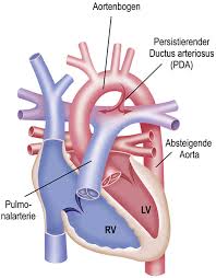 Die periduralanästhesie (auch epiduralanästhesie oder pda genannt) erfreut sich vor allem in angelsächsischen und frankophonen ländern grosser beliebtheit bei den. Persistierender Ductus Arteriosus Pda Dhzb