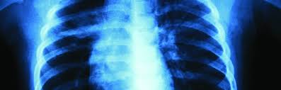 Image result for lung cancer xray