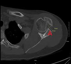 Image result for Chronic Shoulder Dislocation