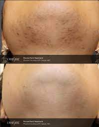 Laser hair removal can be dangerous in inexperienced hands. Laser Hair Removal Ei Con Health Wellness Center