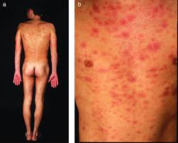 Image result for skin rash acute hiv infection