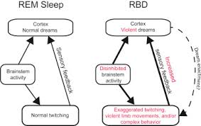 Image result for REM Sleep Behavior Disorder