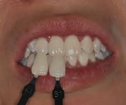 Cases Of In Office Bleaching Prestige Dental Care