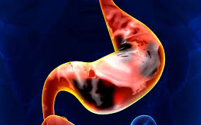 Animation permettant de comprendre les symptômes précoces, l'évolution de symptômes et les traitements possibles du cancer de l'estomac. Definition Cancer De L Estomac Futura Sante