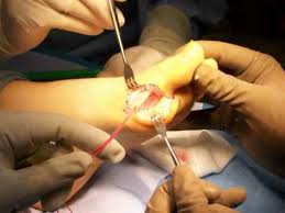 There are three grades of turf toe, 1 being the least serious and 3 being the most serious. Dr Selene Parekh Turf Toe Surgical Case Youtube