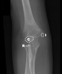 Specific coding for fracture (avulsion) of lateral epicondyle of humerus. Medial Epicondylar Fractures Pediatric Pediatrics Orthobullets