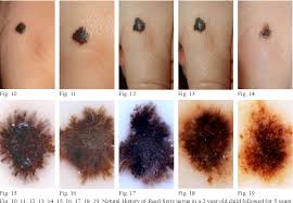 Image result for Spitz Nevus