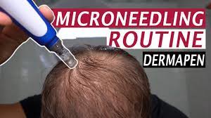If the inflammation is left untreated, it will lead to the miniaturization of the hair follicle which ultimately causes shedding and hair loss. My Microneedling Routine And Derma Rolling For Hair Loss Youtube