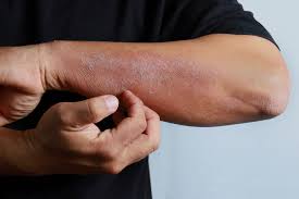 Image result for Radiation Dermatitis