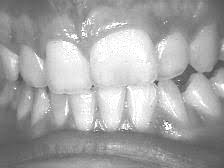 Macrodoncia: los dientes suelen ser más grandes de lo habitual.