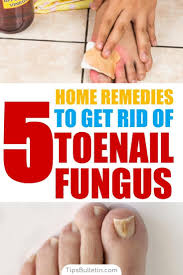 How To Get Rid Of Toenail Fungus 5 Home Remedies In 2020 Toenail Fungus The Cure Toe Nails