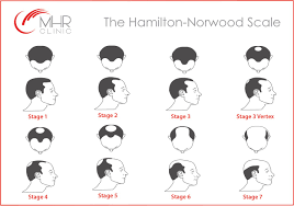 While the most common cause of hair loss is male pattern baldness, there are other potential conditions to make note of when considering why your hair. The Hamilton Norwood Scale Of Baldness Your Hair Treatment