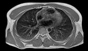Most lung nodules are benign (not cancerous). Lungs Plus A E Mri Scans No Problem Healthcare In Europe Com