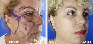 Typically a new straight stairlift will run between $3,000 and $5,000, while curved ones will cost between $10,000 and $15,000. Quick Lift New York City Facelift