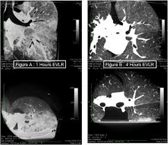 The other main type of liver. Real Time Imaging With The O Arm Of Lung Parenchyma During Ex Vivo Lung Reconditioning The Journal Of Heart And Lung Transplantation