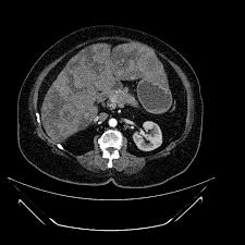 Techniques used to diagnose pancreatic cancer include ultrasound, computerized tomography (ct) scans, magnetic resonance imaging (mri) and, sometimes, positron emission tomography (pet) scans. Hepatic Metastases From Pancreatic Cancer Radiology Case Radiopaedia Org