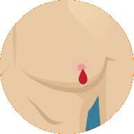 A lump or swelling, which is often (but not always) painless Male Breast Cancer Insurancewith