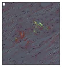 There are several types with varying symptoms; Cardiac Amyloidosis A Congo Red Stain Of Left Ventricle Showing Download Scientific Diagram
