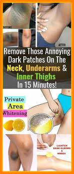 How do you fix dark spots on skin? Inner Thigh Darkness Artofit