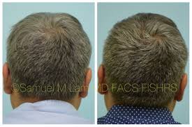 Men who begin to notice a bit of early thinning with hair loss starting at the vertex of their scalp, but who aren't completely bald, have the. Pin On Formula 82 F Topical Finesteride With Minoxidill