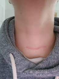 Vom tertiären hyperparathyreoidismus (thpt) sprechen wir, wenn es beim sekundären hyperparathyreoidismus zusätzlich zu einem. Schilddrusen Op Entfernung Der Schilddruse Mein Erfahrungsbericht