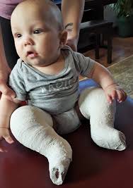 I was born with clubfoot. Clubfoot Treatment At Uihc Providing New Hope For Canadian Boy