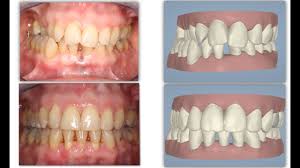 We did not find results for: Amazing Invisalign Crossbite Orthodontic Treatment Incisor Extraction Without Braces Youtube