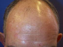 And still others choose one of the treatments available to prevent further hair loss or restore. Hair Loss Dermnet Nz