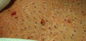 Most hpv infections go away on their own and don't cause any health problems. Feigwarzen Beim Mann I Schnelle Behandlung Inkl Hpv Test
