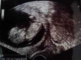 Wenn dich das nervt kannst du ihn kurz und kann man den zwillinge mann erobern mit liebesbriefen? Zwillings Uberraschung Beim Ultraschall Im Letzten Trimester Mamablog Einer Schreit Immer