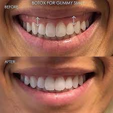 Aug 07, 2019 · a new procedure can correct a gummy smile without having to go under the knife. Botox Gummy Smile Dermatology Botox Botox For Gummy Smile Lip Flip