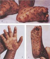 Image result for Burttia prunoides