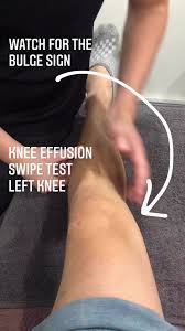 Image result for Knee Bulge Sign