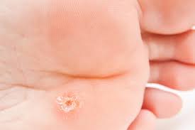 Image result for verrucae filiformes