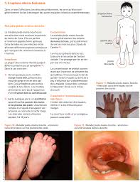 Particulièrement contagieuse, cette maladie infantile est reconnaissable à ses petits boutons. Facebook